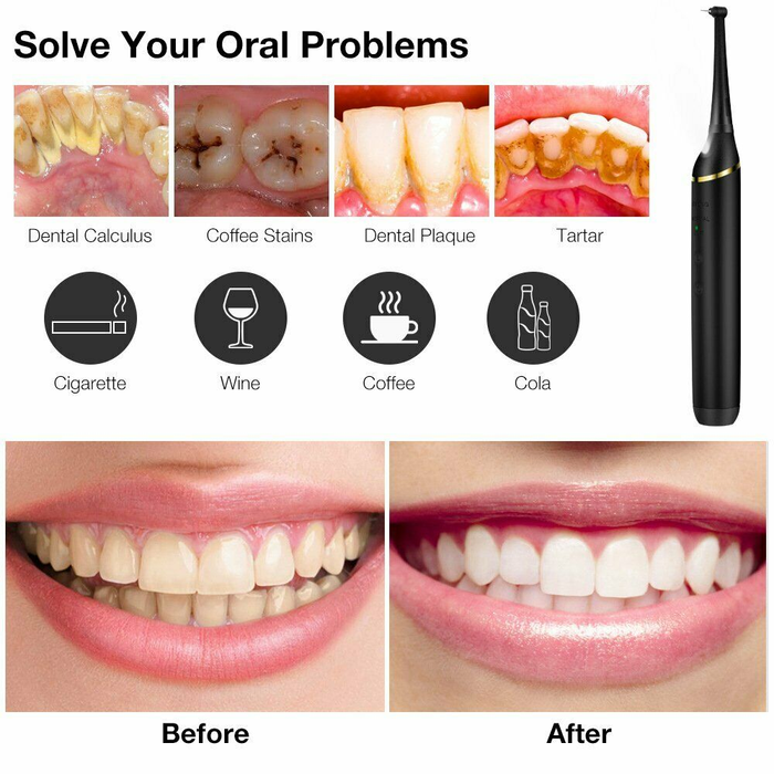 Electric Dental Calculus Remover Tooth Cleaner